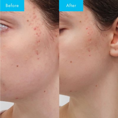 Niacinamid serum med Bakuchiol - Niacinamide Ultra 5 Serum
